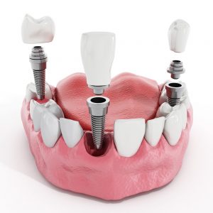dental implants in Encino, CA
