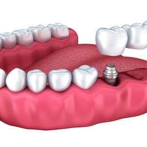 dental implants, bridge and crowns