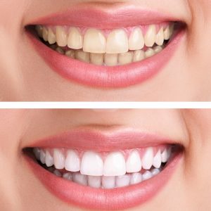 teeth whitening by Dr. Linda Makuta, DDS